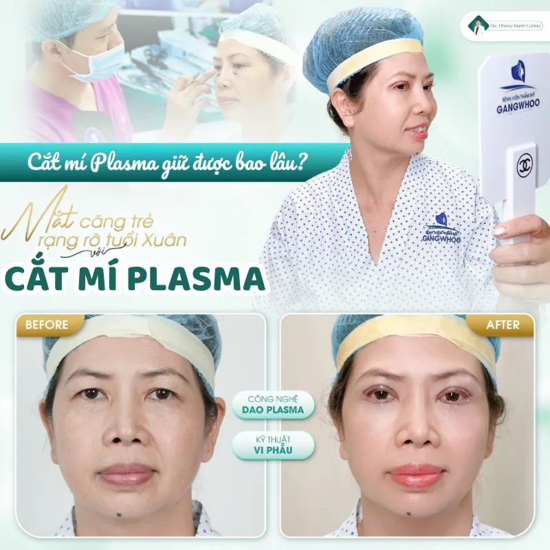Cắt mí plasma là gì? Review cắt mí plasma có tốt không? 13 Sau khi cắt mí plasma. mí mắt sẽ vào form ổn định từ 5 - 7 ngày
