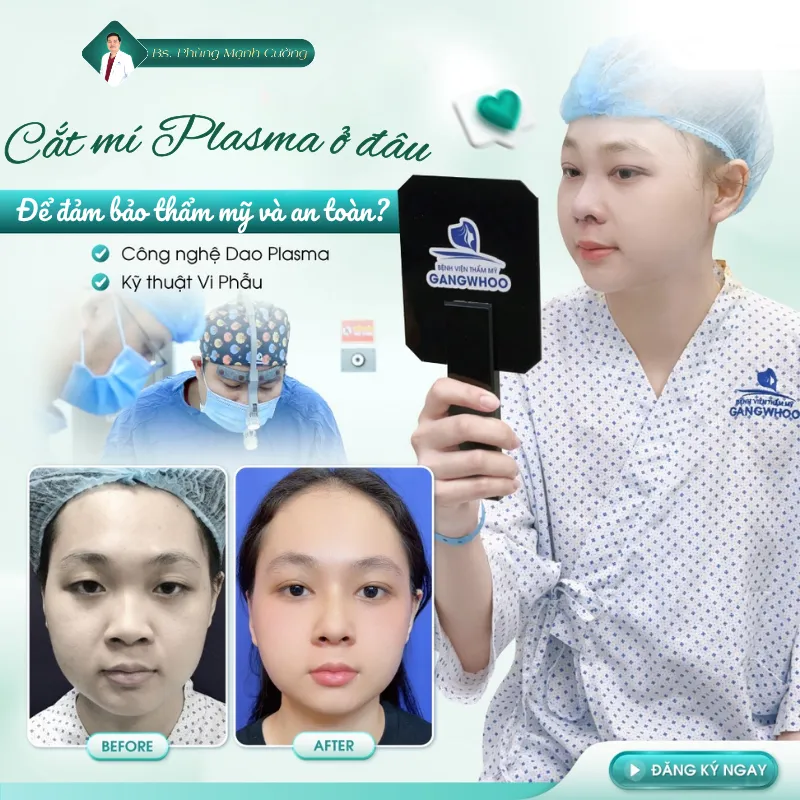 Cắt mí plasma giá bao nhiêu? Cắt mí plasma giữ được bao lâu?