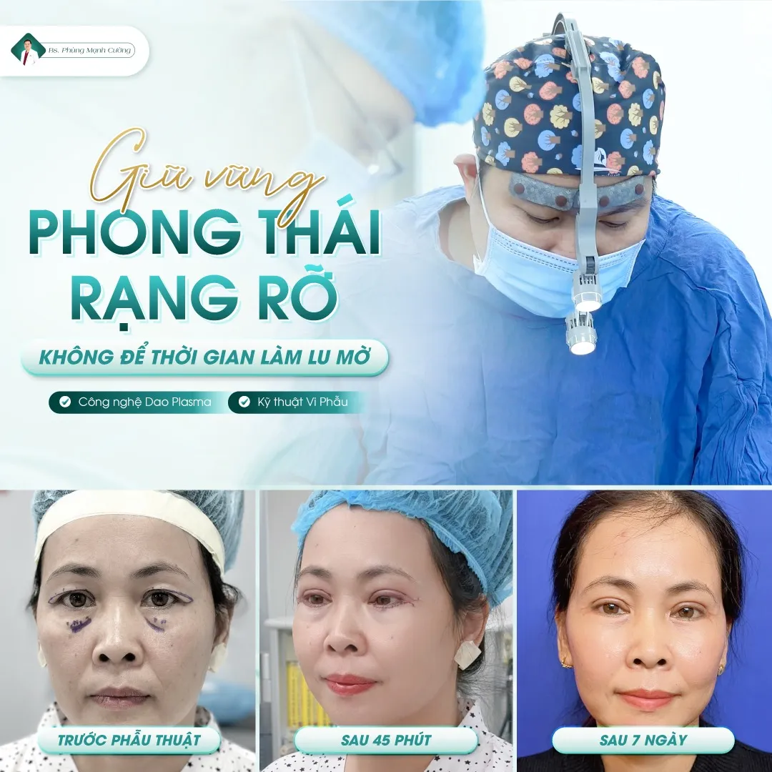 Cắt mí plasma là gì? Review cắt mí plasma có tốt không? 14 Sau khi cắt mí plasma từ 5-7 mí mắt sẽ vào form ổn định