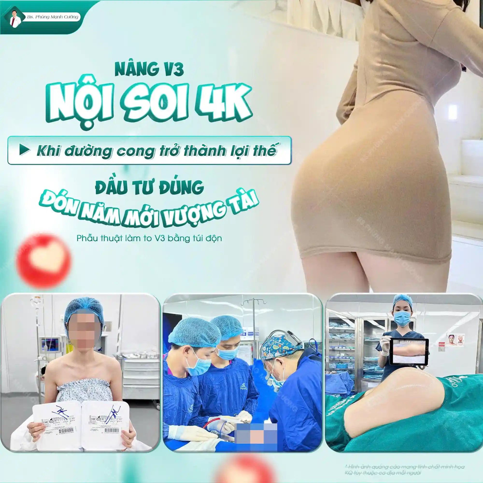 Nâng mông công nghệ cao là gì? Có những công nghệ nào? 16 Tìm hiểu thế nào là nâng mông công nghệ cao