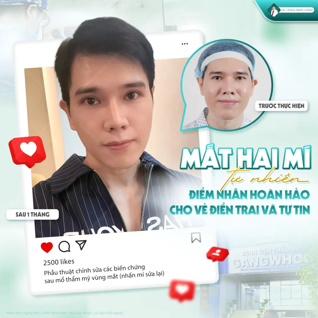 Cách khắc phục vấn đề bấm mí không đều