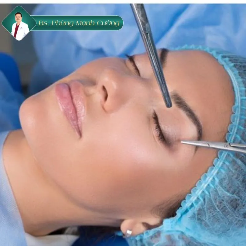 Nguyên nhân cắt mí bị hở