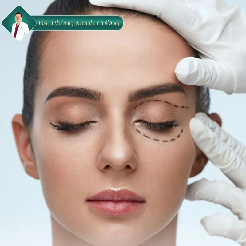 Cắt mí bị lệch có sửa được không? Sửa cắt mí lệch ở đâu? 10 Cách khắc phục tình trạng cắt mí bị lệch