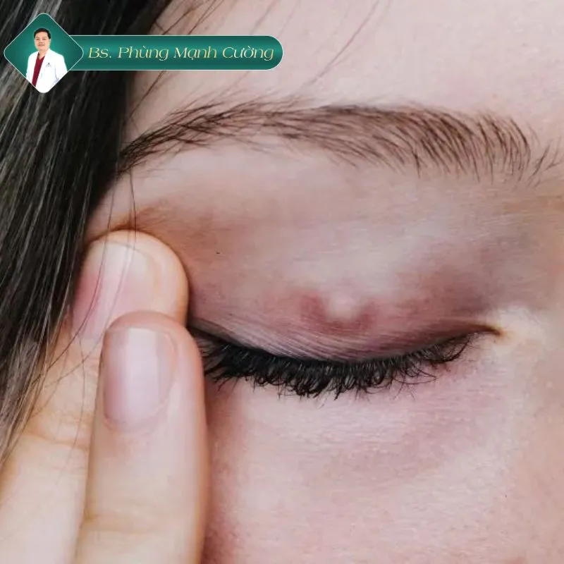 Cắt mí mắt bị nhiễm trùng: Triệu chứng và cách xử lý 8 Nguyên nhân ắt mí mắt bị nhiễm trùng