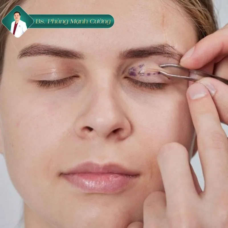 Cắt mí bị sẹo lồi phải làm sao? Hướng dẫn chi tiết từ bác sĩ 7 Nguyên nhân cắt mí bị sẹo lồi