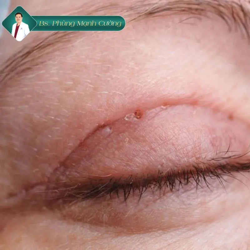 Cắt mí bị sẹo lồi phải làm sao? Hướng dẫn chi tiết từ bác sĩ 6 Thế nào là cắt mí bị sẹo lồi