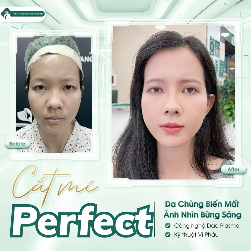 Cắt mí bao nhiêu tiền? Giá cắt mí mắt mới nhất hiện nay 39 cắt mí dưới