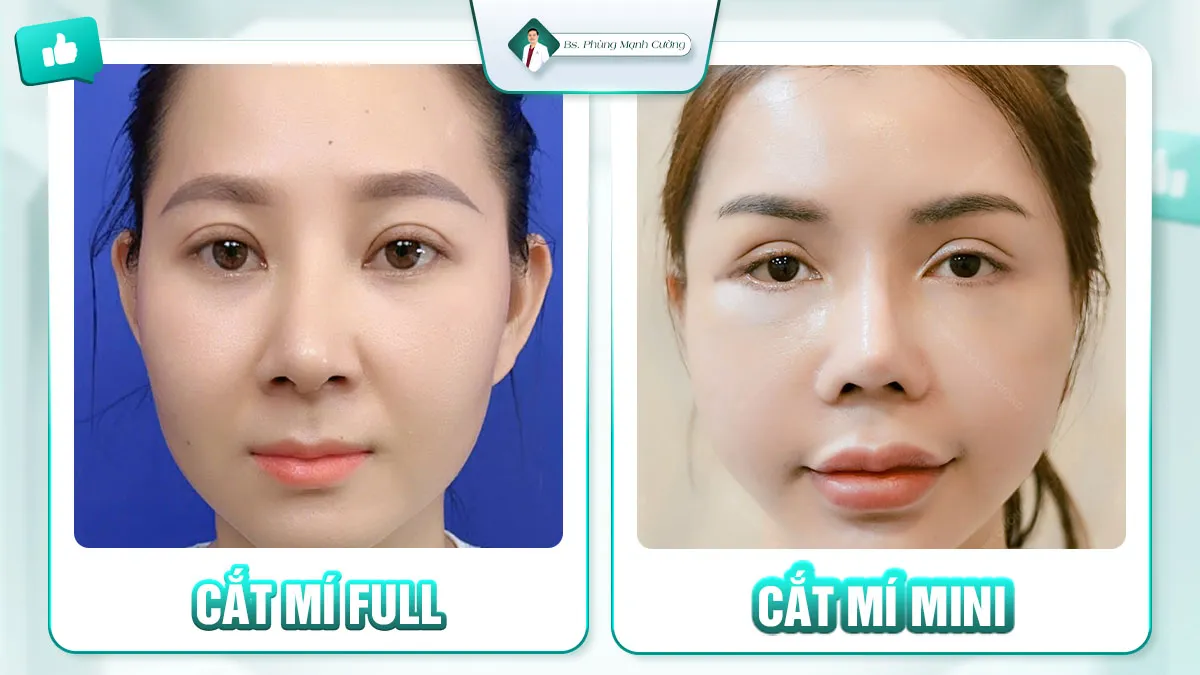 So sánh cắt mí full và mini