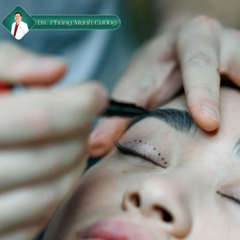 Phẫu thuật sửa mí mắt không đều 