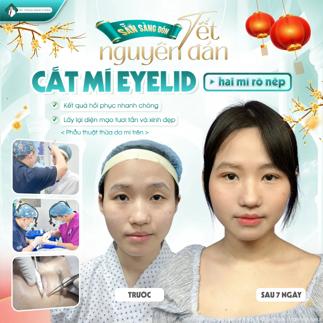 Tìm hiểu thế nào là size cắt mí đẹp và phù hợp