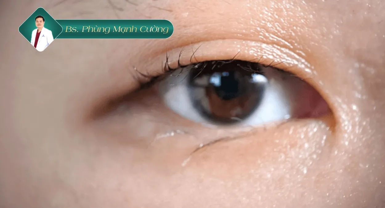 Tìm hiểu dáng mắt cụp là như thế nào