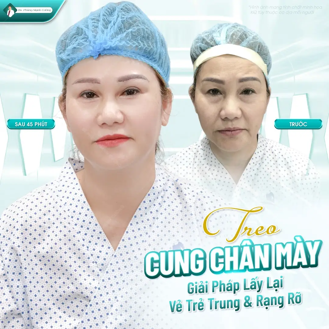 Tiêu chí đánh giá địa chỉ nâng chân mày đẹp