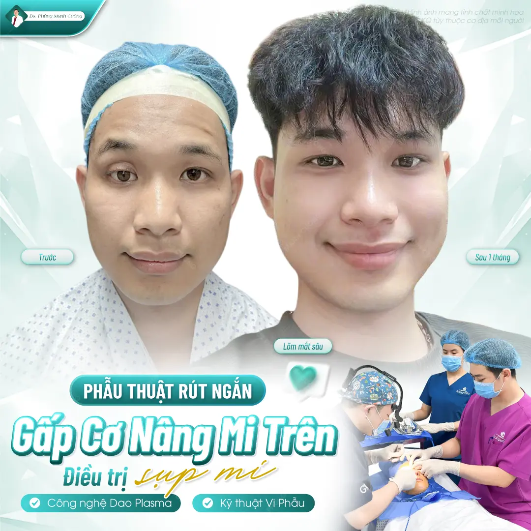 Nâng cơ mắt giúp cải thiện sụp mí và tầm nhìn hiệu quả