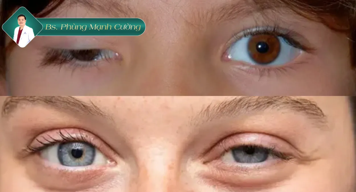 Tìm hiểu về bệnh nhược cơ mắt