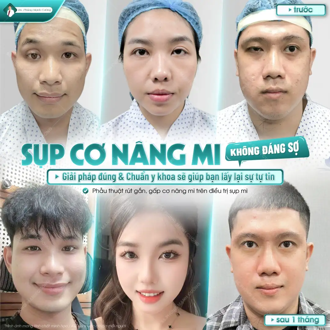 Tùy theo tình trạng sụp mí, chi phí phẫu thuật có thể thay đổi