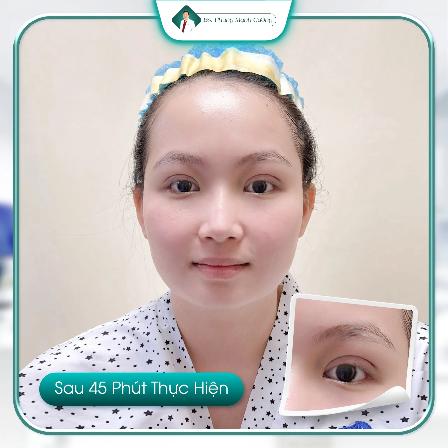 Cắt mí bị lệch có sửa được không? Sửa cắt mí lệch ở đâu? 11 Phẫu thuật sửa cắt mí bị lệch