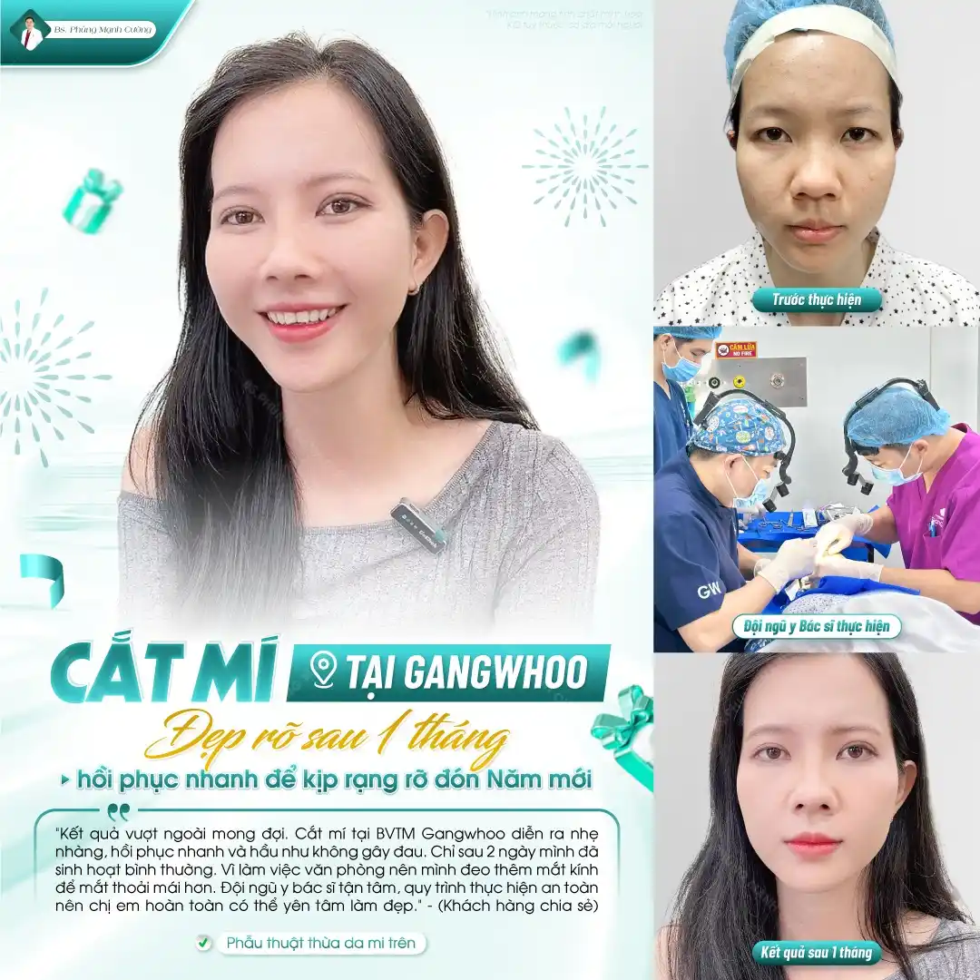 Cắt mí plasma là phương pháp được nhiều khách hàng lựa chọn