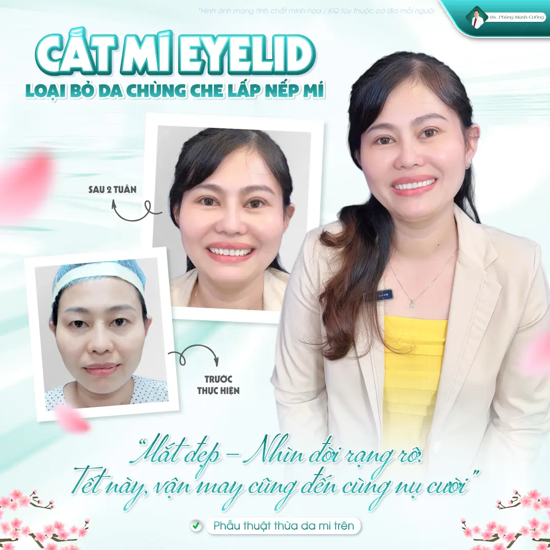 Cắt mí eyelid mang lại sự trẻ trung cho đôi mắt