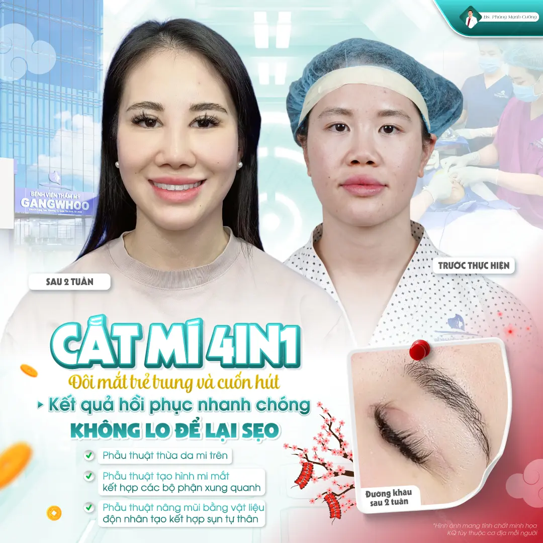 Giá cắt mí plasma dao động từ 7 đến 10 triệu