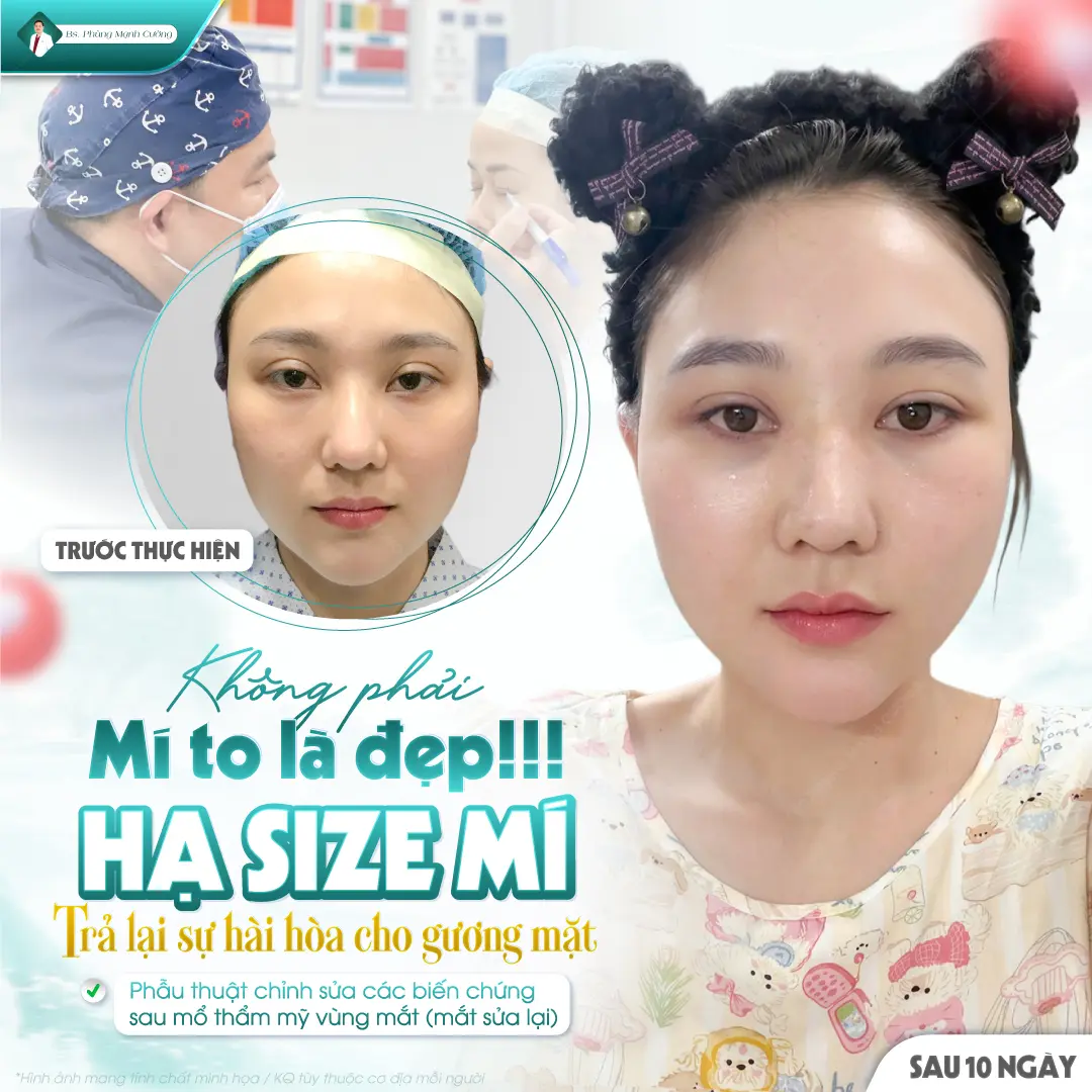 Tiêu chuẩn cắt mí thế nào là đẹp? Bác sĩ giải đáp chi tiết 9 Cắt mí mắt đẹp cần đảm bảo độ dài lý tưởng