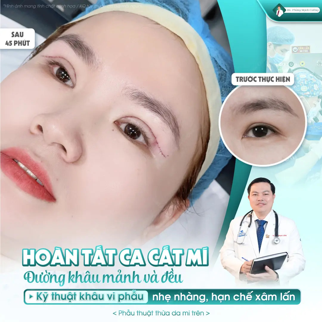 Tiêu chuẩn cắt mí thế nào là đẹp? Bác sĩ giải đáp chi tiết 8 Tiêu chuẩn cắt mí thế nào là đẹp