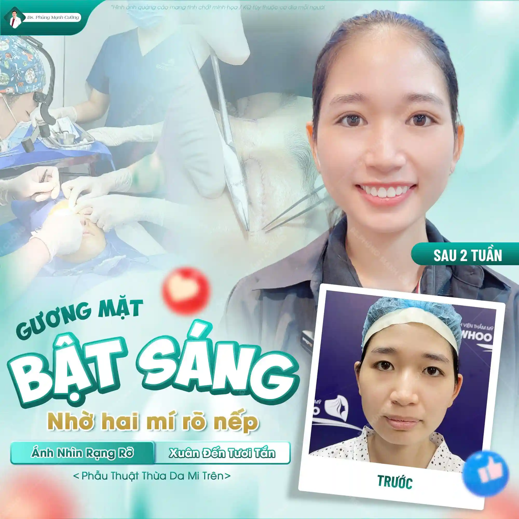 Có nên cắt mí mắt không? Tư vấn chi tiết từ bác sĩ