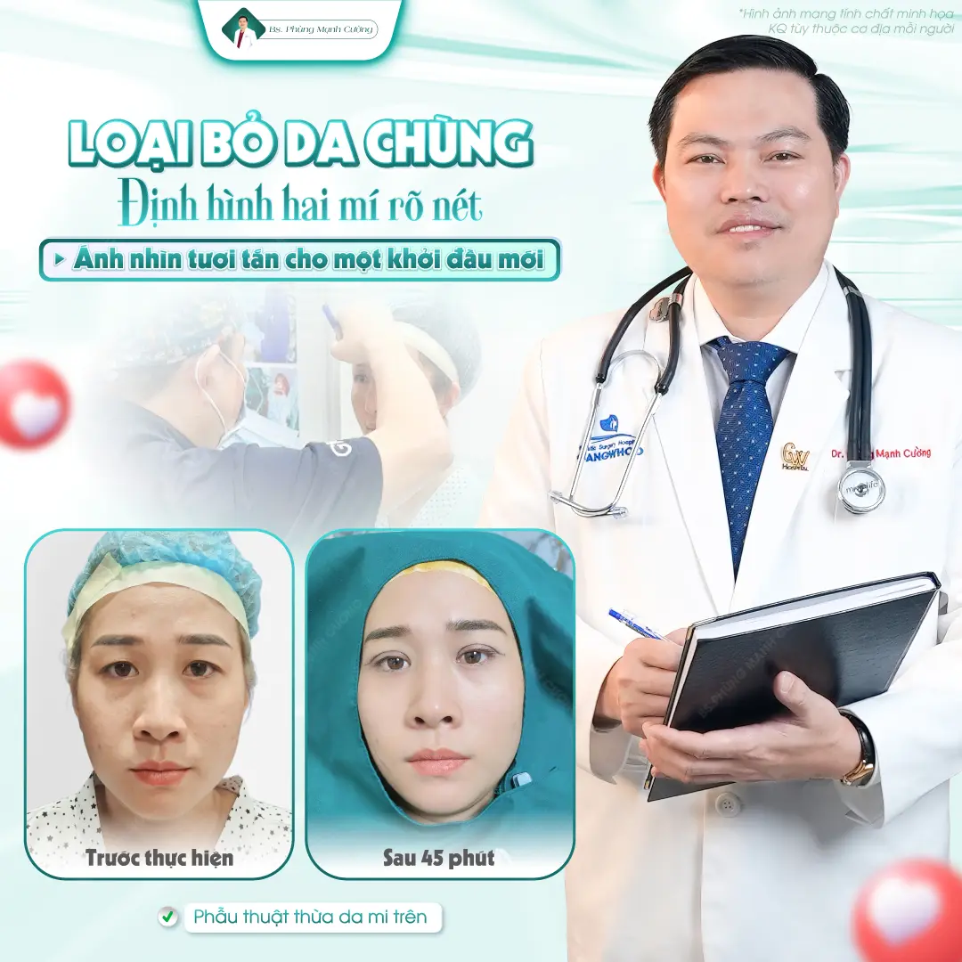 Lợi ích của phẫu thuật cắt mí mắt