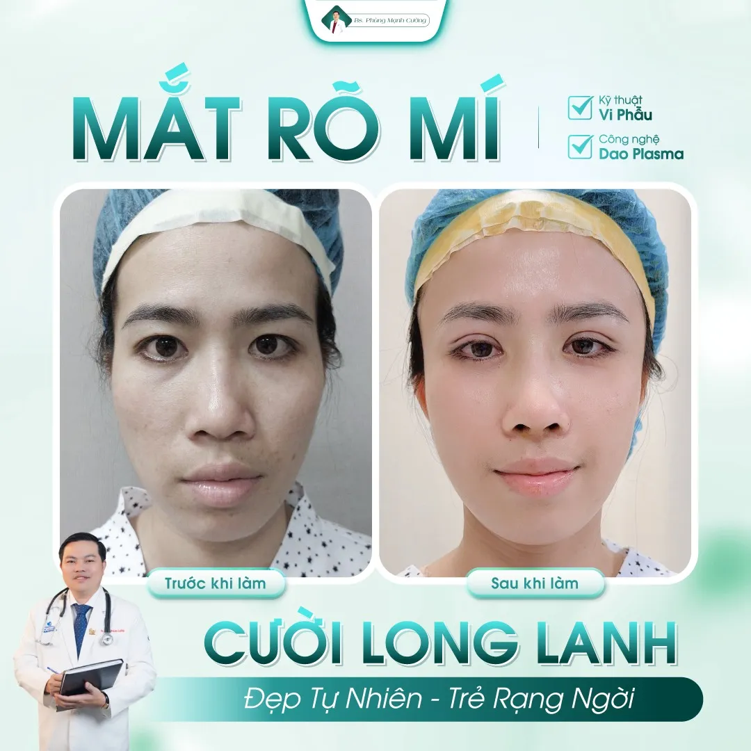 Cắt mí bao nhiêu tiền? Giá cắt mí mắt mới nhất hiện nay 35 Hình ảnh khách hàng cắt mí eyelid tại bác sĩ Cường