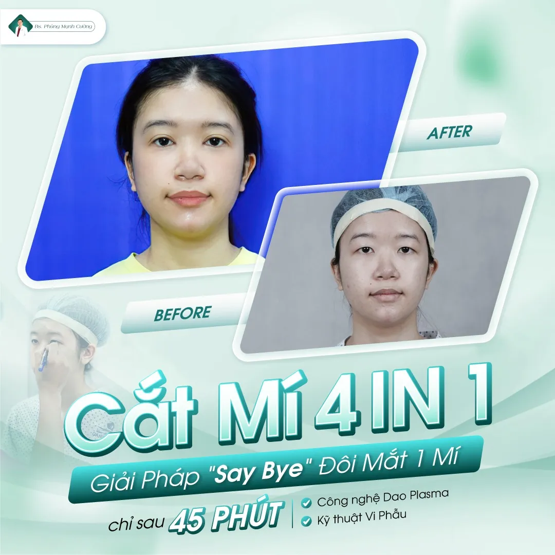 Cắt mí bao nhiêu tiền? Giá cắt mí mắt mới nhất hiện nay 31 Hình ảnh khách hàng cắt mí 4 in 1 tại bác sĩ Cường