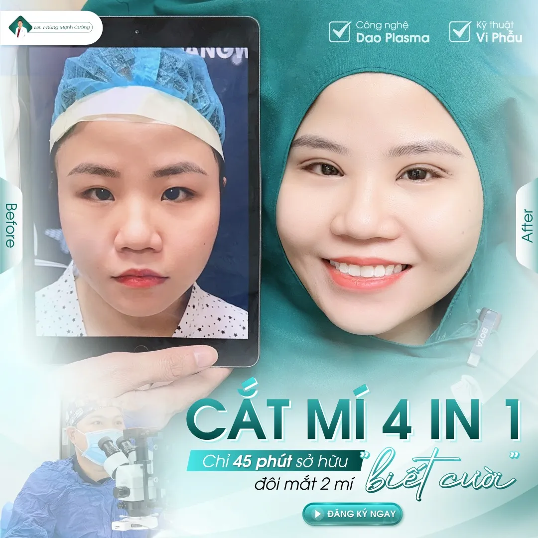 Cắt mí bao nhiêu tiền? Giá cắt mí mắt mới nhất hiện nay 30 Hình ảnh khách hàng cắt mí 4 in 1 tại bác sĩ Cường