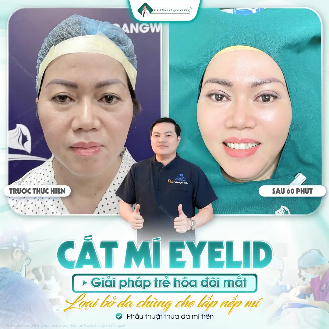 Công nghệ cắt mí mắt có ảnh hưởng đến chi phí