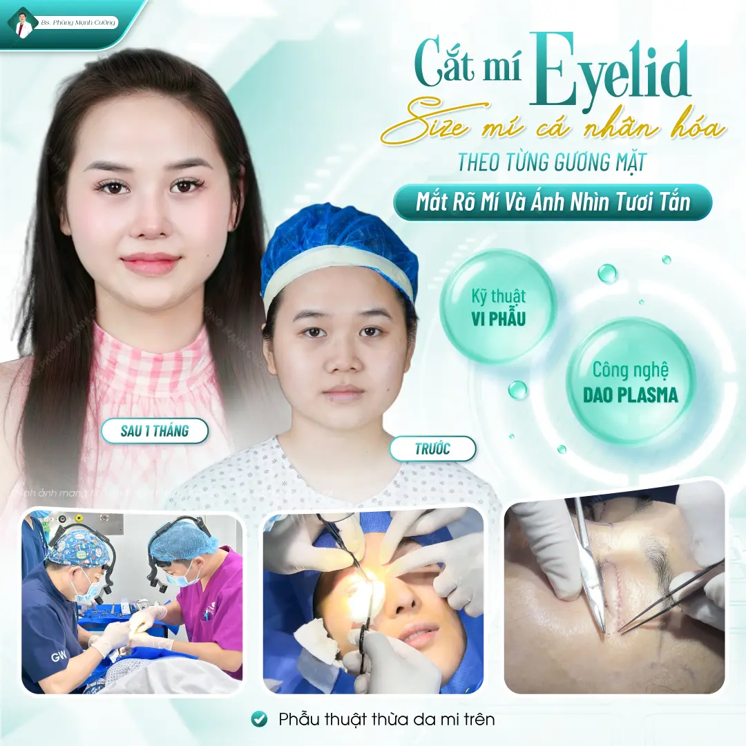 Các chi phí đã bao gồm trong dịch vụ cắt mí