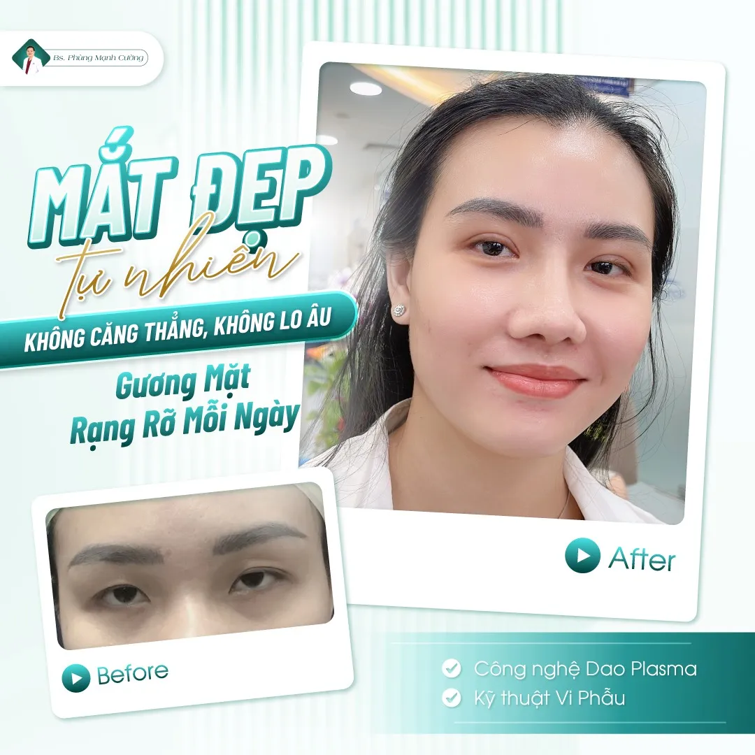 Cắt da thừa mí mắt có nguy hiểm không? Những lưu ý an toàn 5 Tìm hiểu cắt da thừa mí mắt có nguy hiểm không