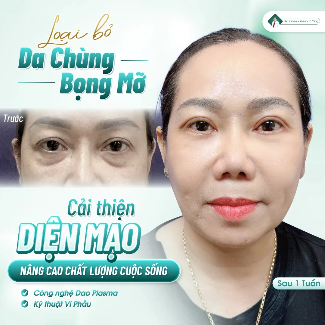 Khách hàng sau khi thực hiện cắt mí mắt do bác sĩ Phùng Mạnh Cường thực hiện