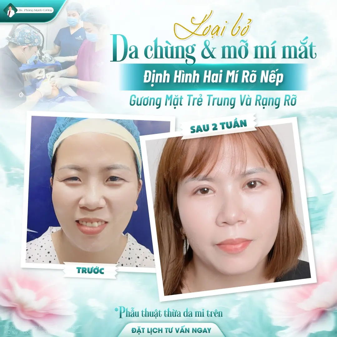 Phẫu thuật cắt mí trên: Chi phí, quy trình và những lưu ý 11 Cắt da thừa mí trên giải quyết tình trạng da chùng mí mắt