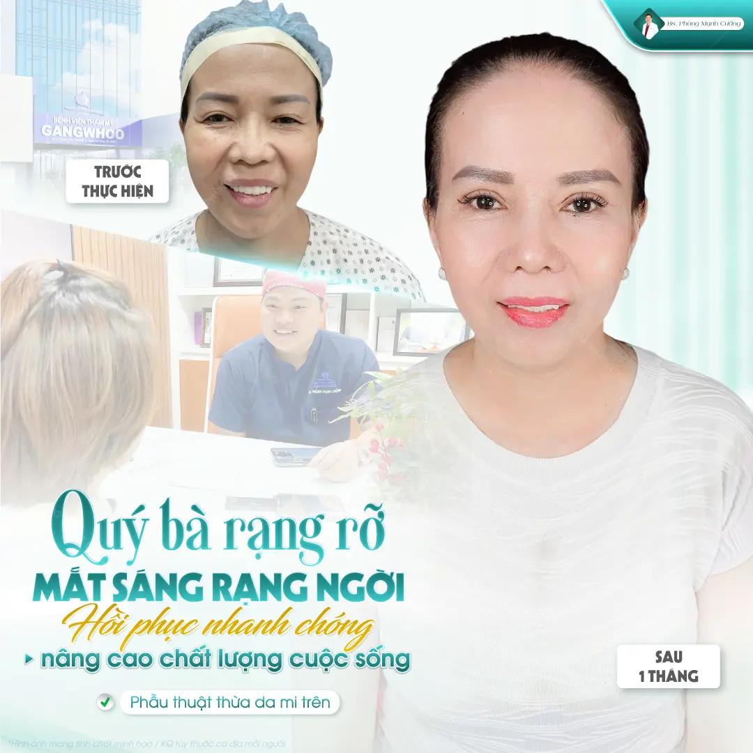 Phẫu thuật cắt mí trên: Chi phí, quy trình và những lưu ý 8 Phẫu thuật cắt mí trên và những điều cần biết