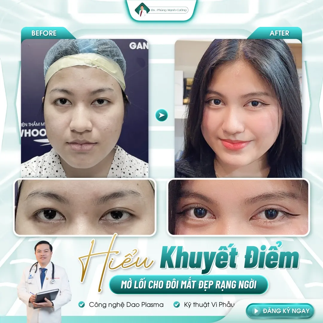 Tham khảo hình ảnh khách hàng sau khi cắt mí mắt tại bác sĩ Cường