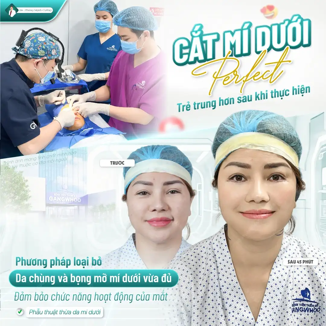 Cắt mí bao lâu hết sưng tùy vào cơ địa từng khách hàng