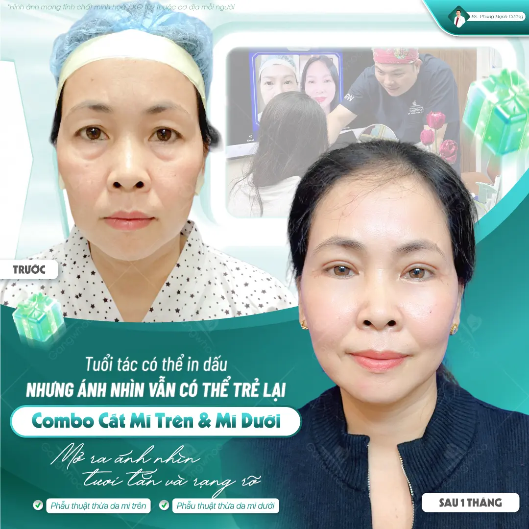 Tìm hiểu các giai đoạn phục hồi sau cắt mí