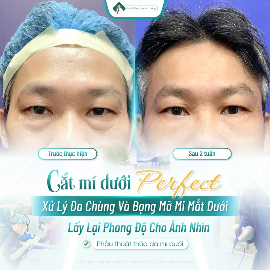 Cắt mí mắt dưới giá bao nhiêu? Giá cắt mí dưới mới nhất 7 Các yếu tố ảnh hưởng đến giá cắt mí dưới