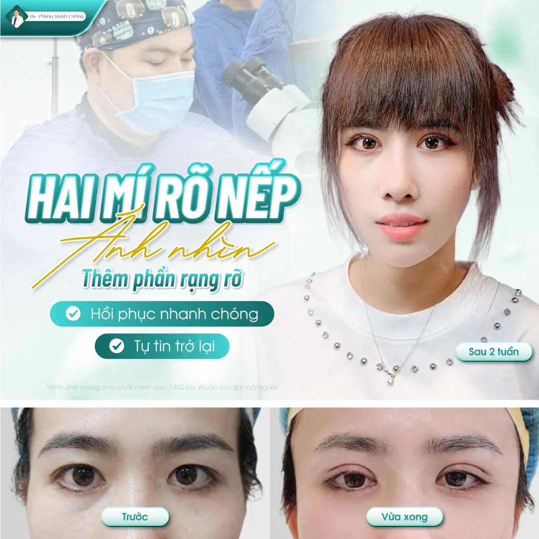 Tiêu chí lựa chọn địa cắt mí mắt ở Cần Thơ uy tín