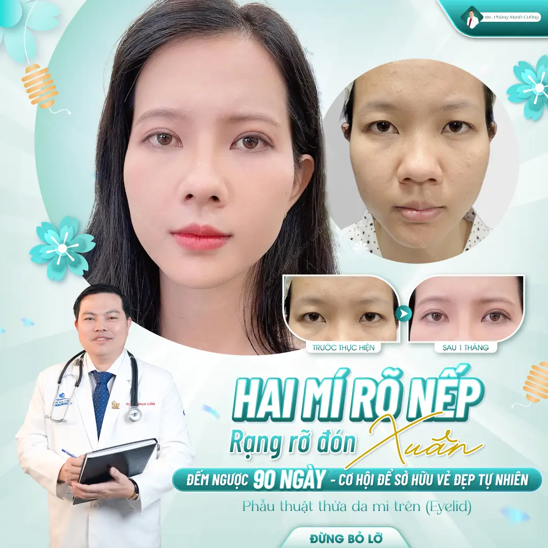 Lý do nên chọn cắt mí mắt tại Bác sĩ Phùng Mạnh Cường