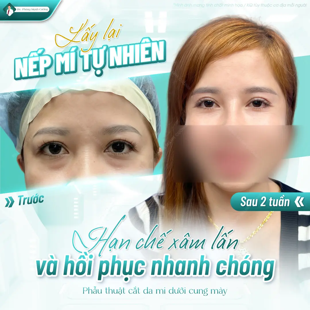Tiêu chí chọn địa chỉ cắt mắt 2 mí uy tín ở Đà Nẵng