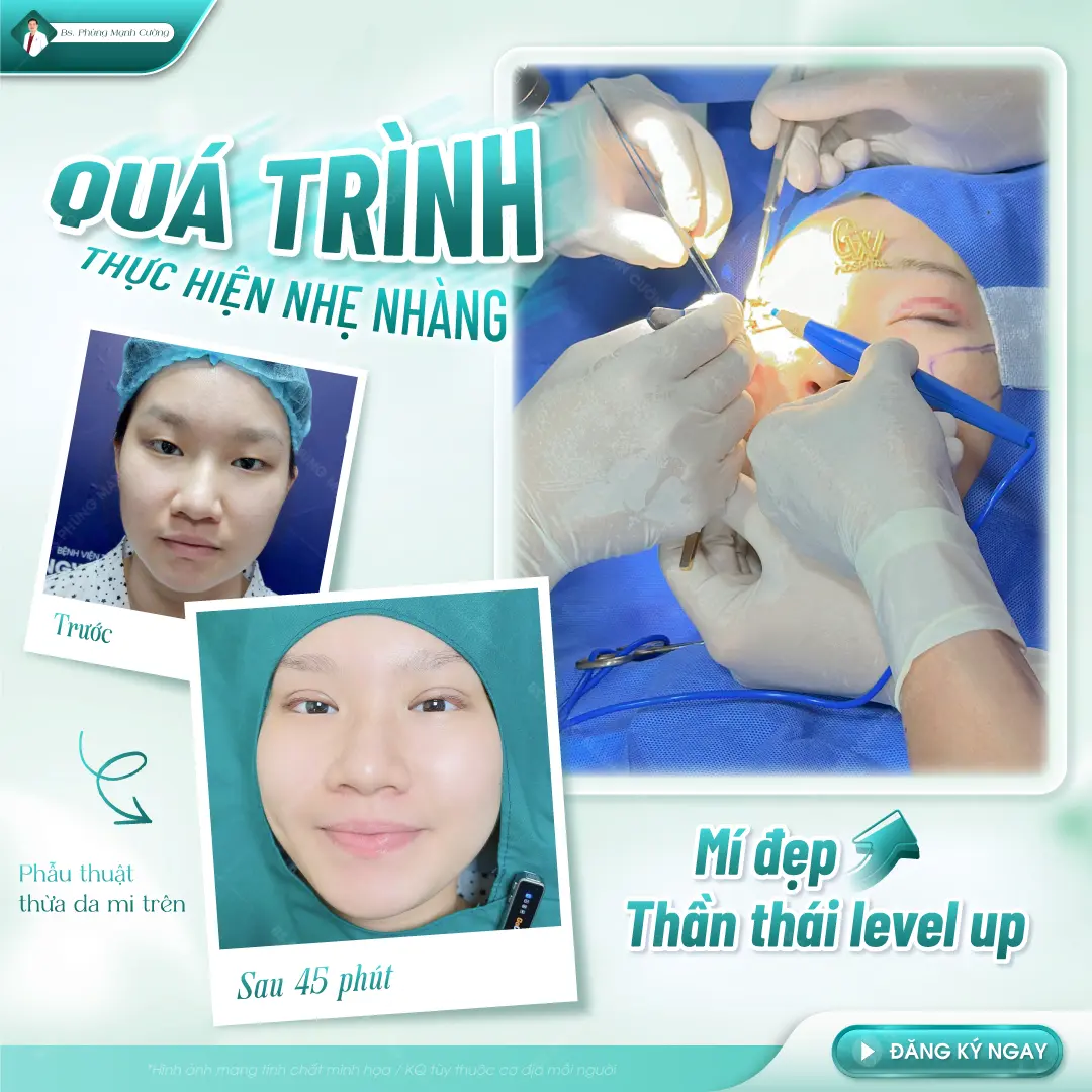 TIêu chí đánh giá cơ sở cắt mí ở Quy Nhơn uy tín