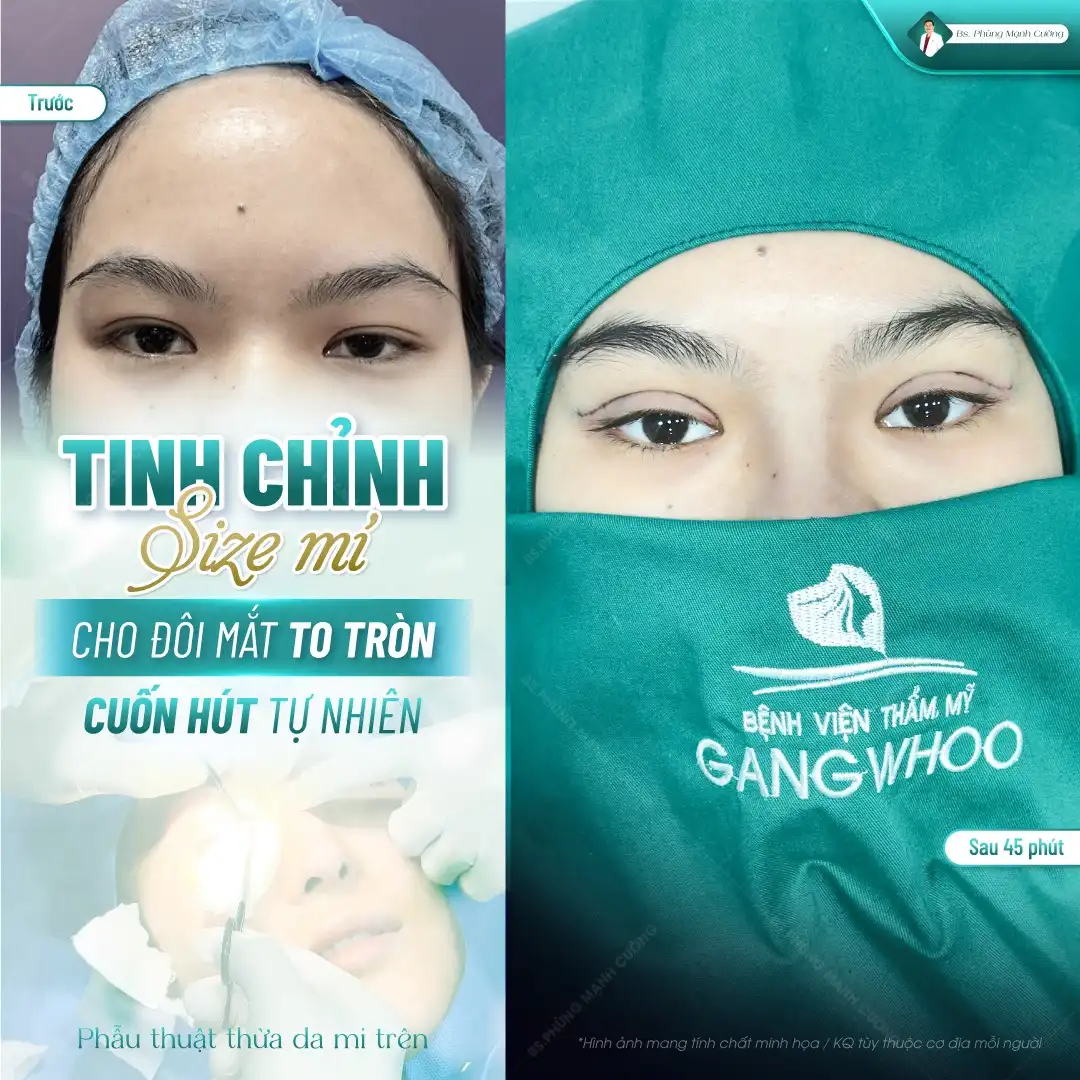 Cắt mí ở Vinh: Gợi ý 5 địa chỉ chất lượng cao, đáng tin cậy 6 Tiêu chí lựa chọn địa chỉ cắt mí ở Vinh