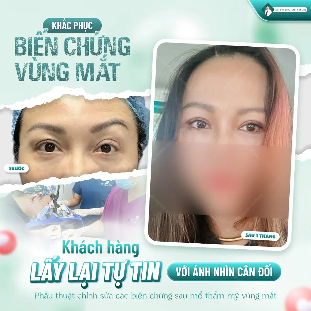 Cắt mí ở Vinh: Gợi ý 5 địa chỉ chất lượng cao, đáng tin cậy 7 Tham khảo kết quả thực tế từ khách hàng