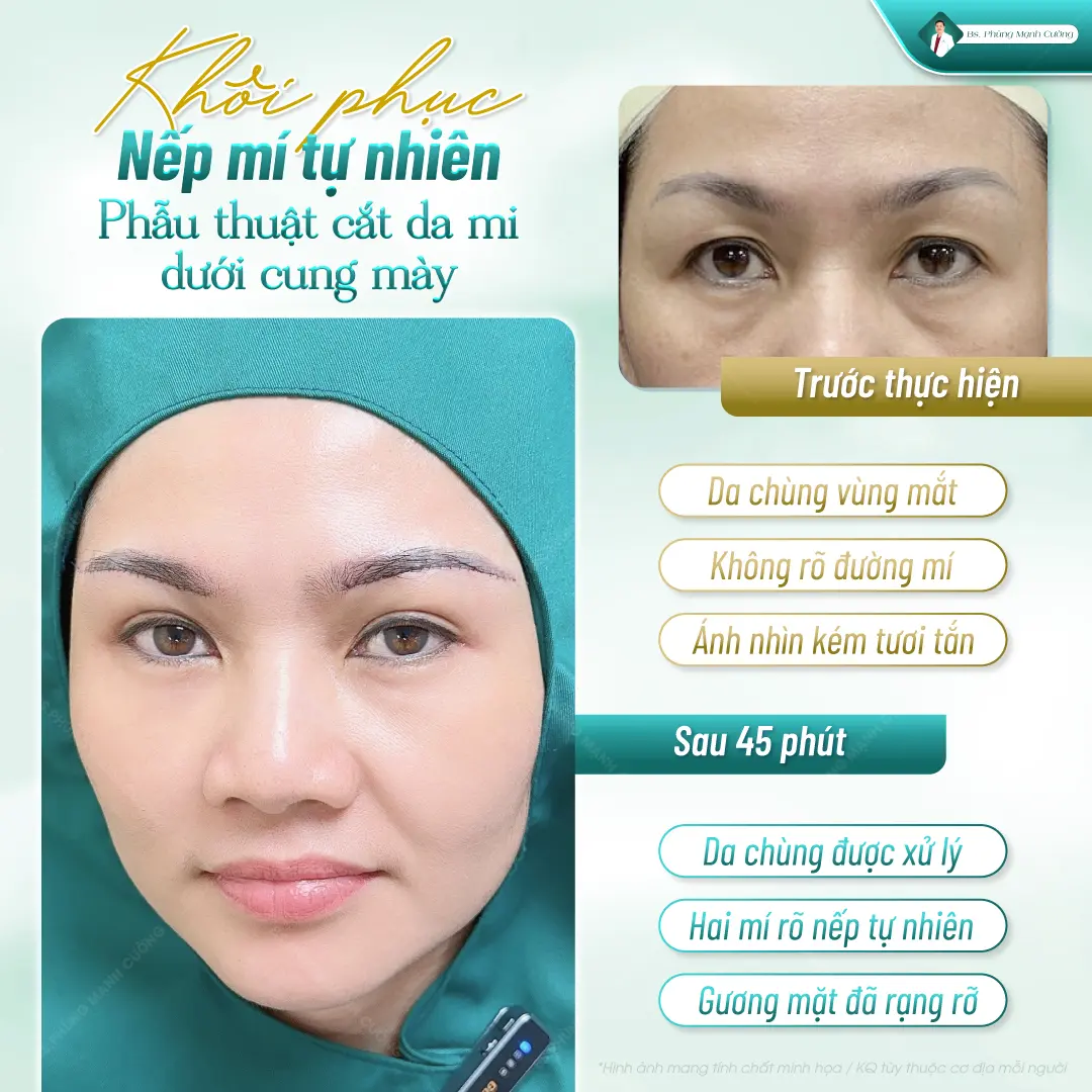 Top 4 địa chỉ cắt mí mắt ở Hải Phòng đáng tin cậy 7 Bác sĩ Phùng Mạnh Cường - Địa chỉ cắt mí mắt uy tín