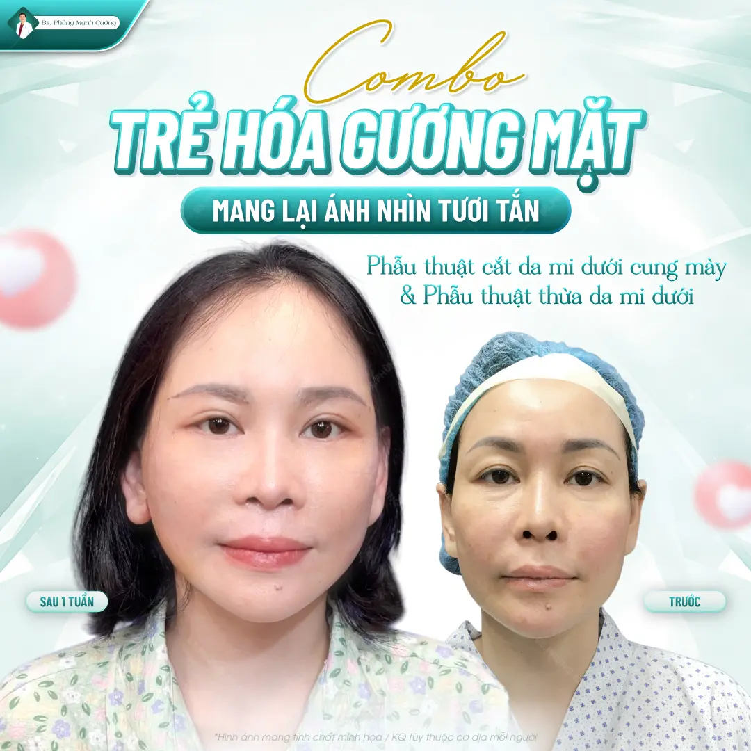 Top 4 địa chỉ cắt mí mắt ở Hải Phòng đáng tin cậy 6 Giá cắt mí mắt hiện nay dao động từ 8-15 triệu