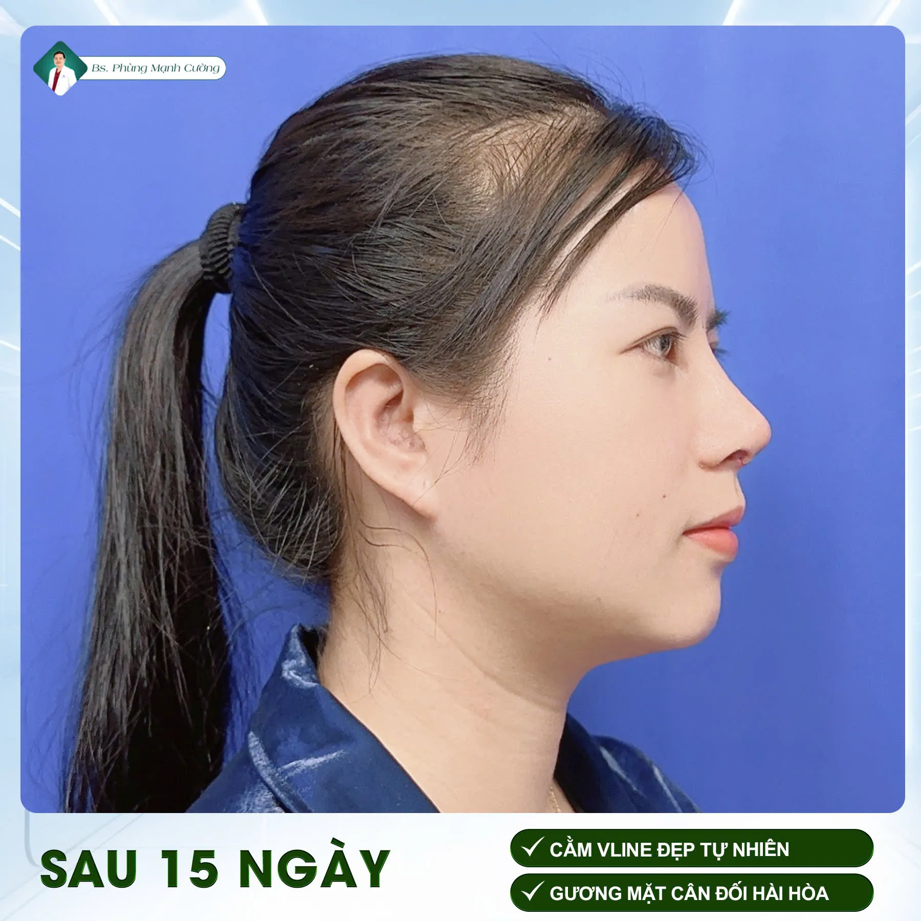 Giải đáp độn cằm bao lâu thì đẹp