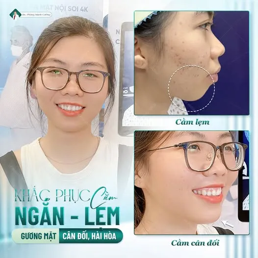 Độn cằm bao lâu mới đẹp